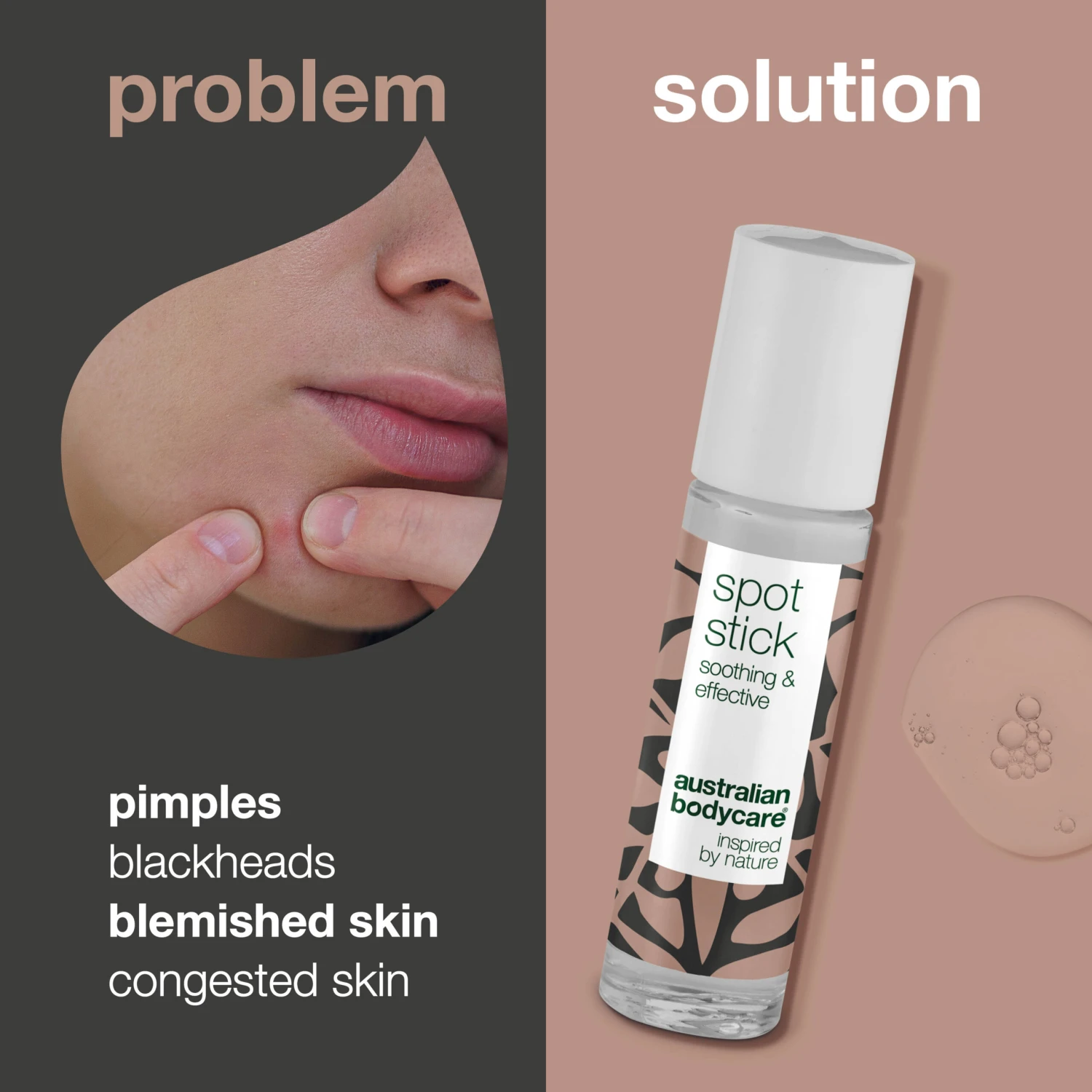 Australian Bodycare Tea Tree Oil Spot Treatment For Congested Skin — For The Daily Care Of Acne And Effective Against Blemished Skin, Pimples And Blackheads. - Image 2