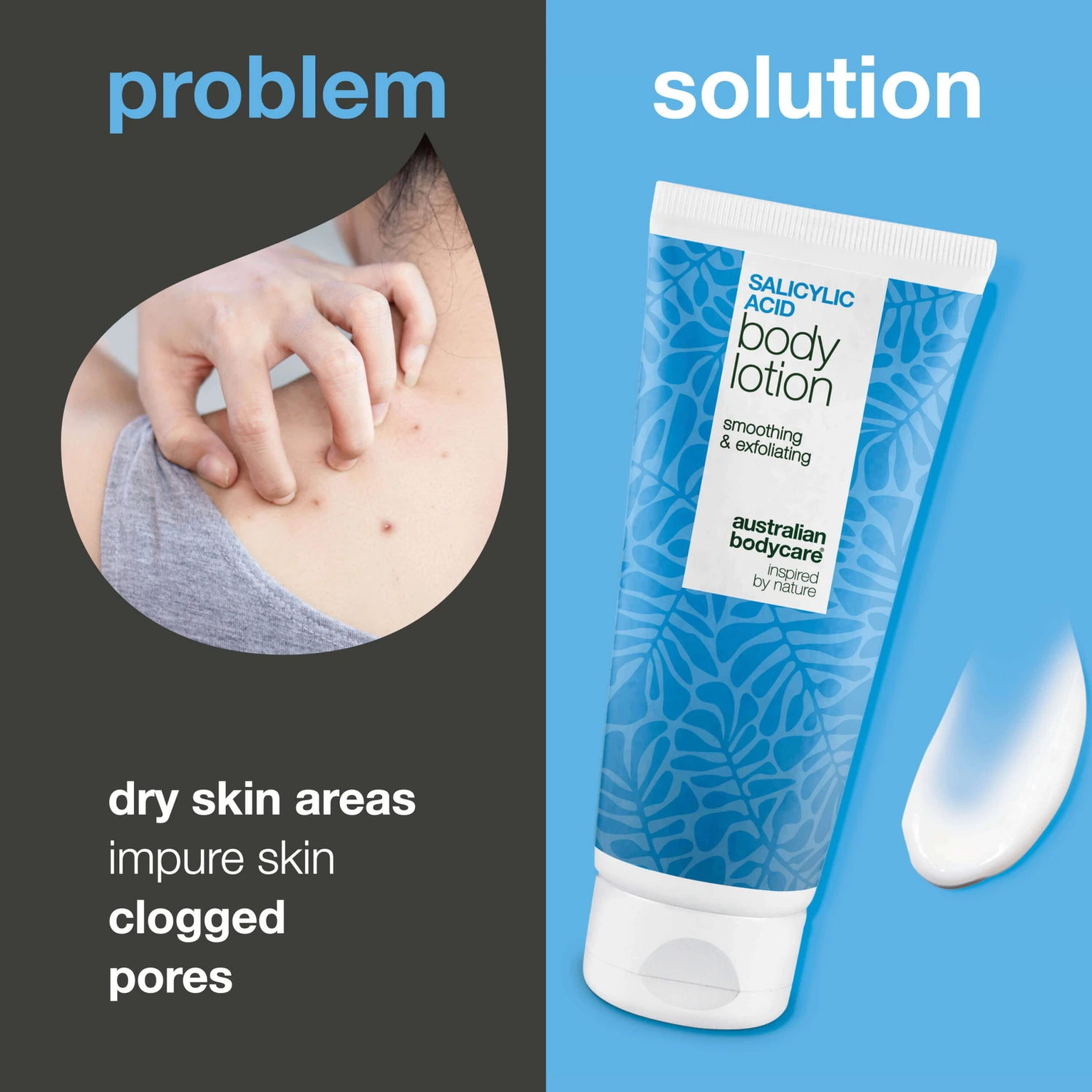 Australian Bodycare Body Lotion With Salicylic Acid – For Blemishes And Dry Skin — Body Lotion With Salicylic Acid Exfoliates, Hydrates, And Helps Reduce Blemishes, Uneven Texture, And Dry Skin. Perfect For Daily Use. - Image 2